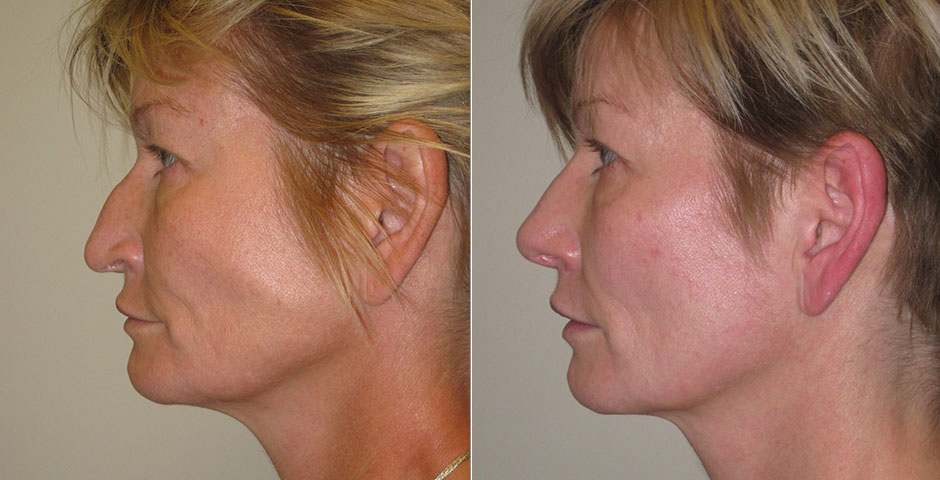 Rhinoplasty Before & After Photo