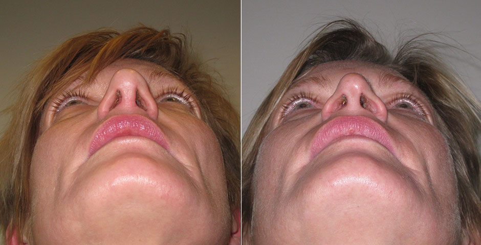 Rhinoplasty Before & After Photo