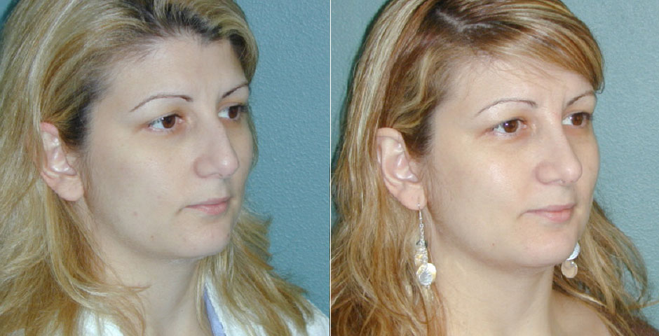 Rhinoplasty Before & After Photo