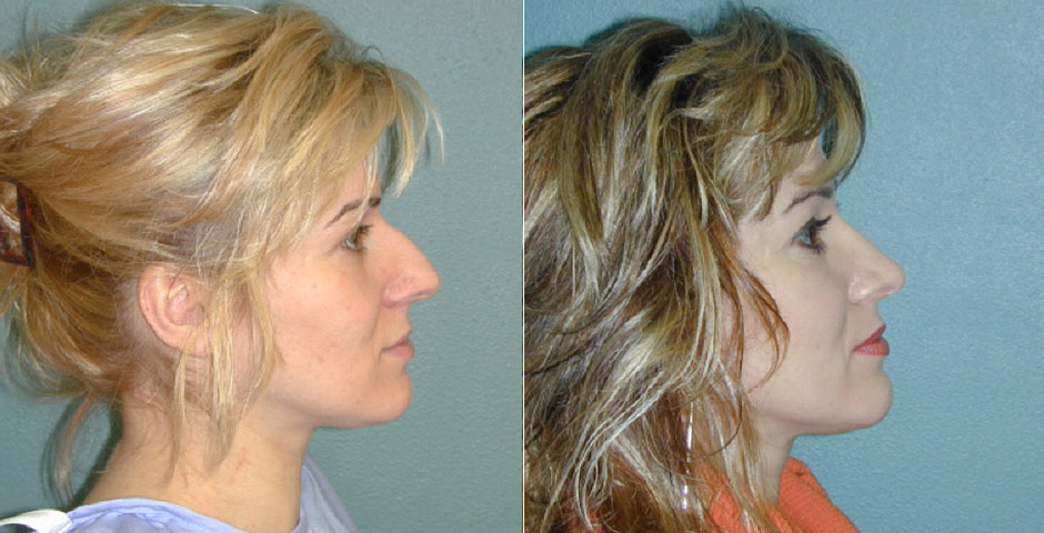 Rhinoplasty Before & After Photo