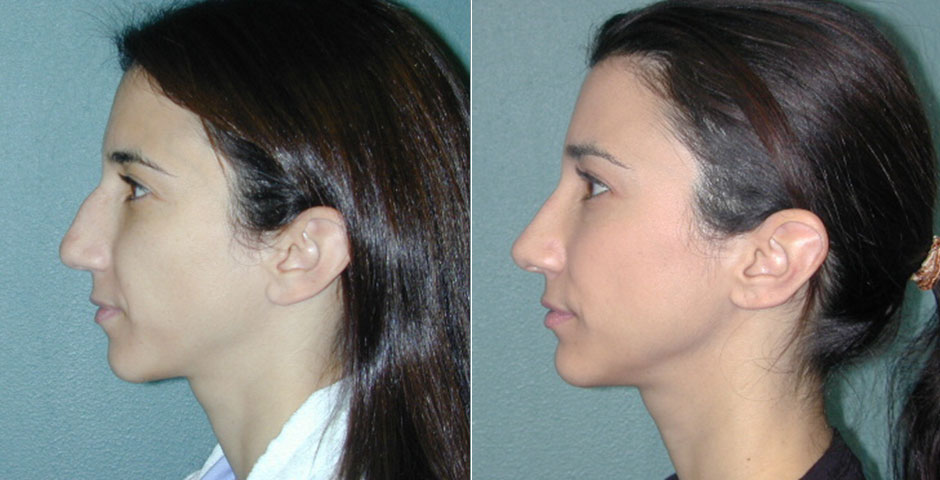 Rhinoplasty Before & After Photo