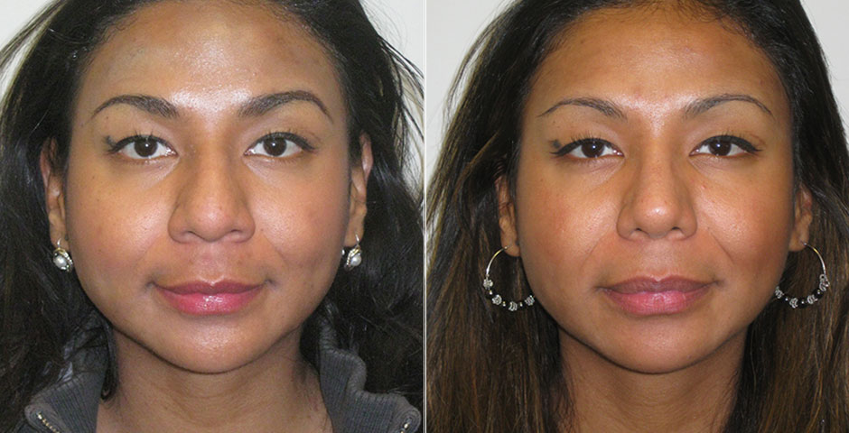 Rhinoplasty Before & After Photo