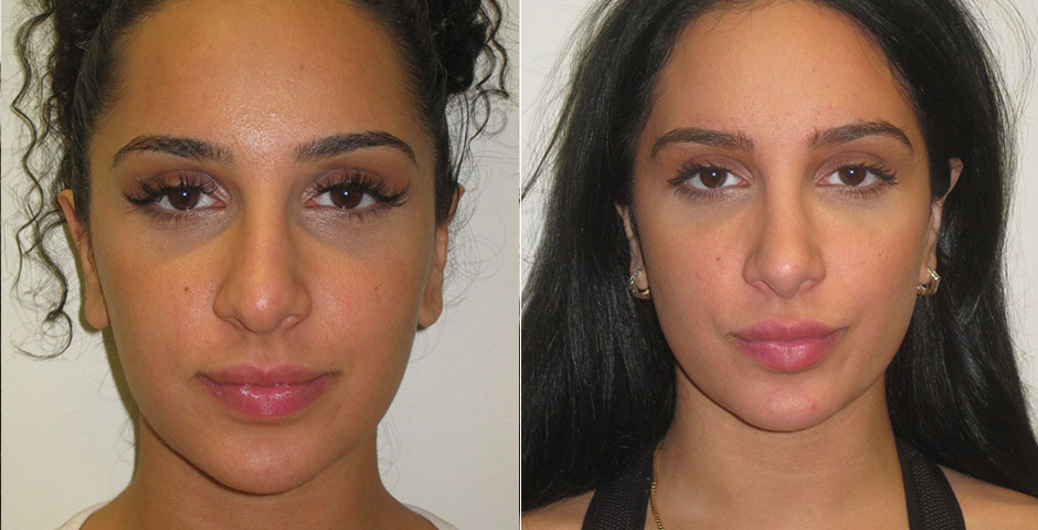 Rhinoplasty Before & After Photo