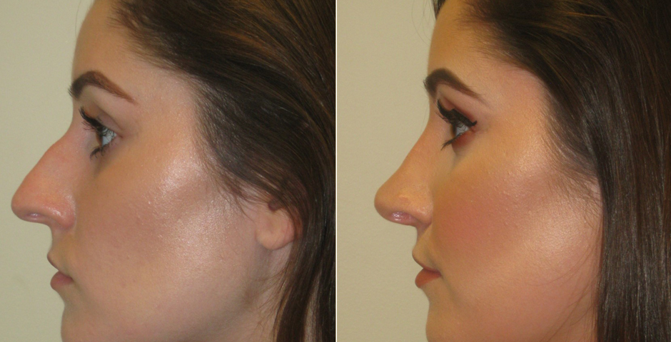 rhinoplasty-gallery_4