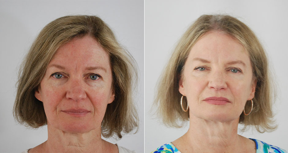 SoftLift Facial Rejuvination Before & After Photo