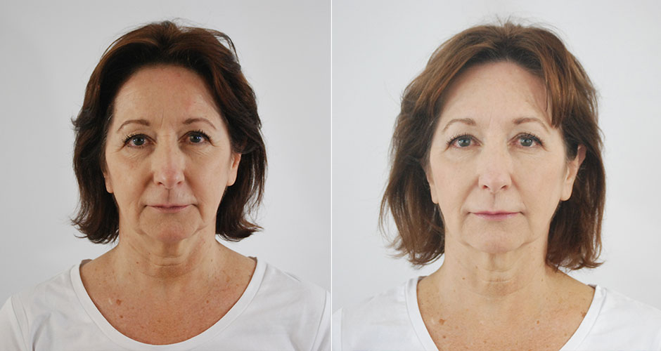 SoftLift Facial Rejuvination Before & After Photo