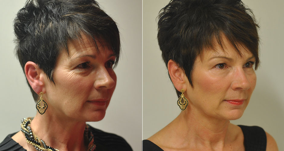 SoftLift Facial Rejuvination Before & After Photo