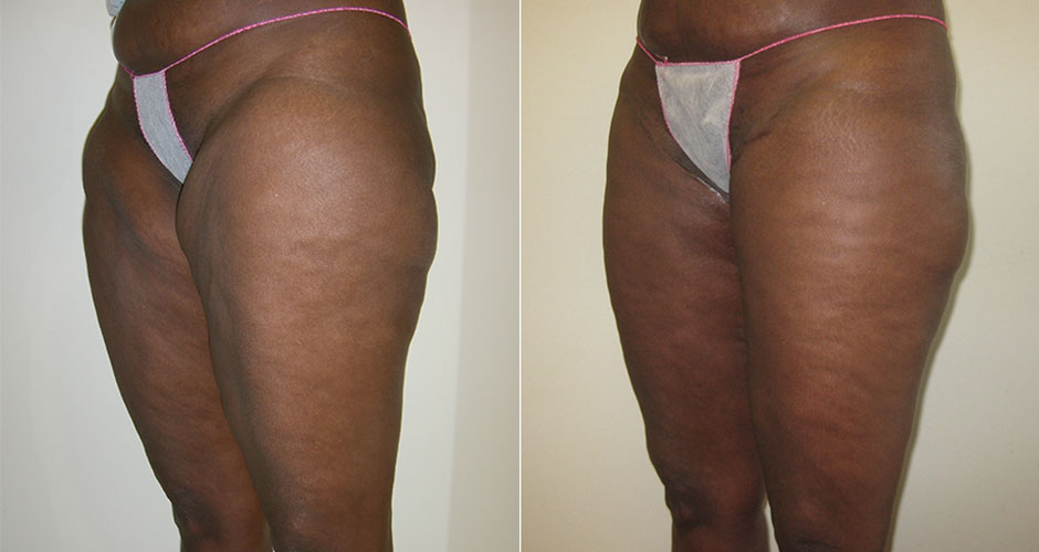 Thigh Lift Before & After Photo