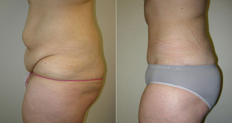 Tummy Tuck Toronto  Canadian Plastic Surgery Centre