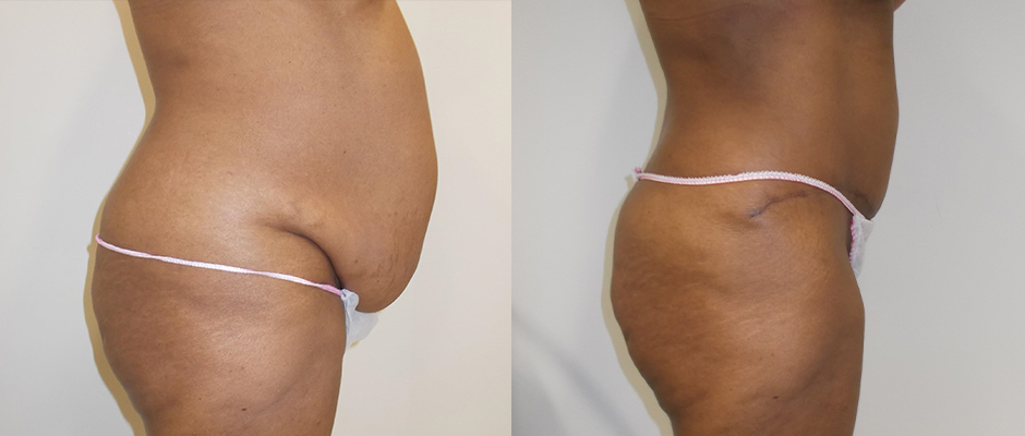 Achieve a Flatter, Firmer Abdomen with Tummy Tuck in Toronto