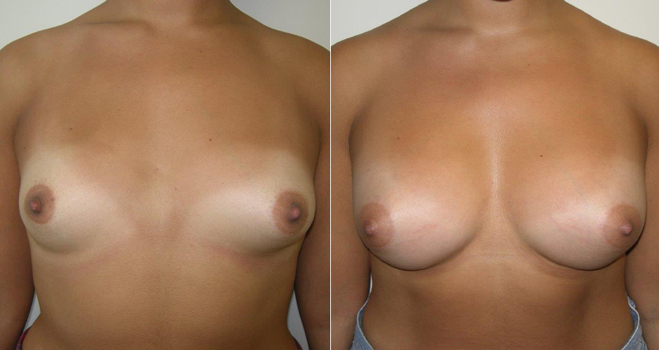 before and after breast augmentation with fat transfer