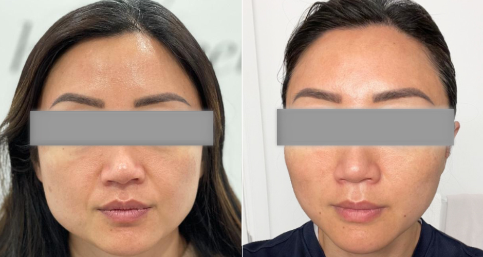 Thread Lift Before & After Photo