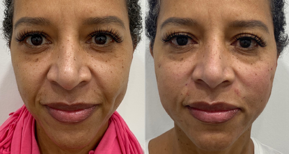 Thread Lift Before & After Photos