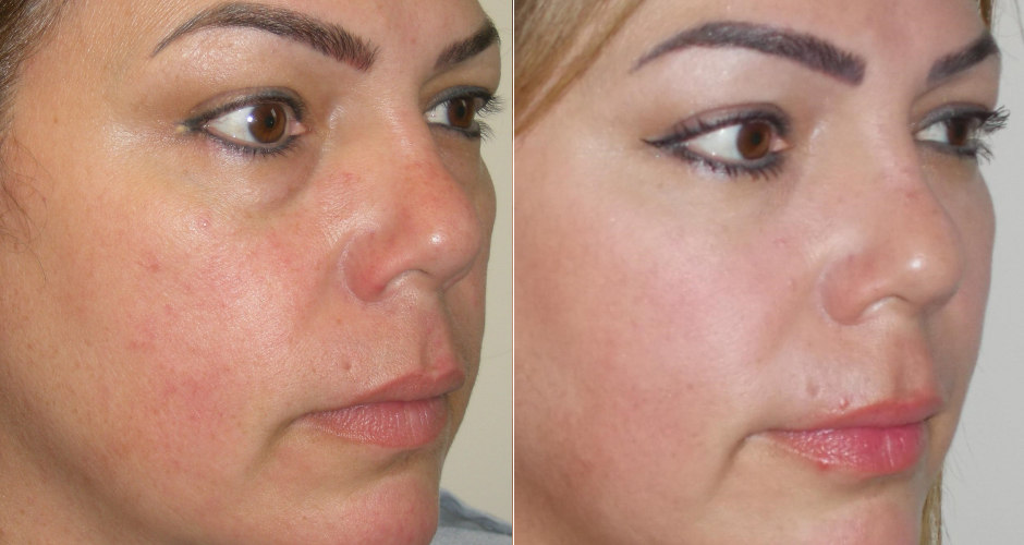 Blepharoplasty Before and After Photo