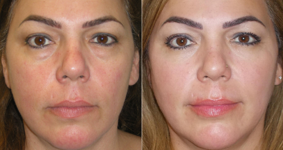 Blepharoplasty Before and After Photo