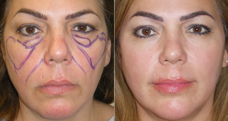 Blepharoplasty Before and After Photo