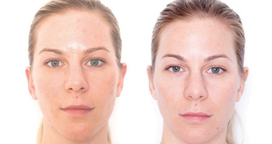 Miracle 10 Facial Peel Before and After Photo