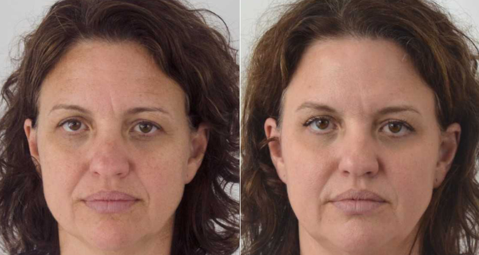 Miracle 10 Facial Peel Before and After Photo