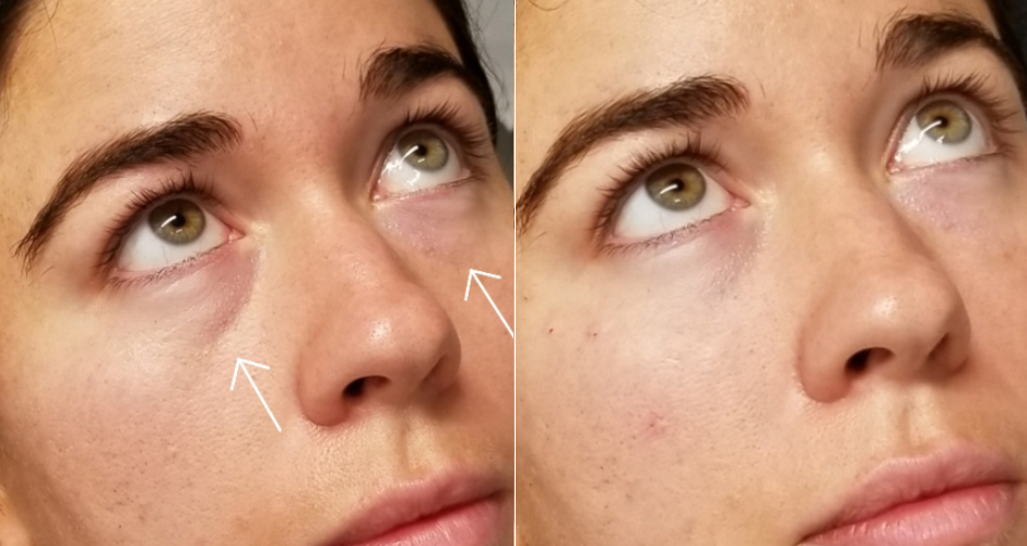 Redensity II Under Eye Treatment Before & After Photo