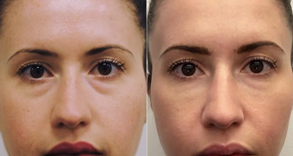 Redensity II Under Eye Treatment Before & After Photo