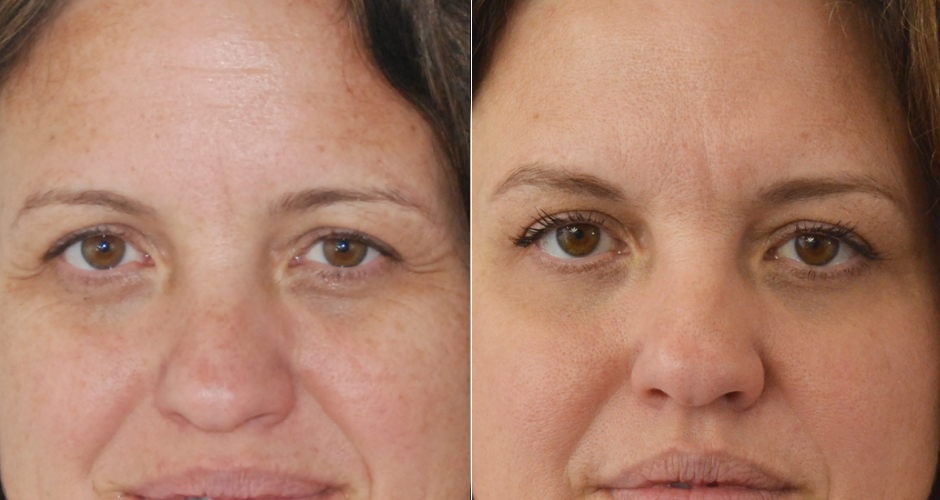 Redensity II Under Eye Treatment Before & After Photo