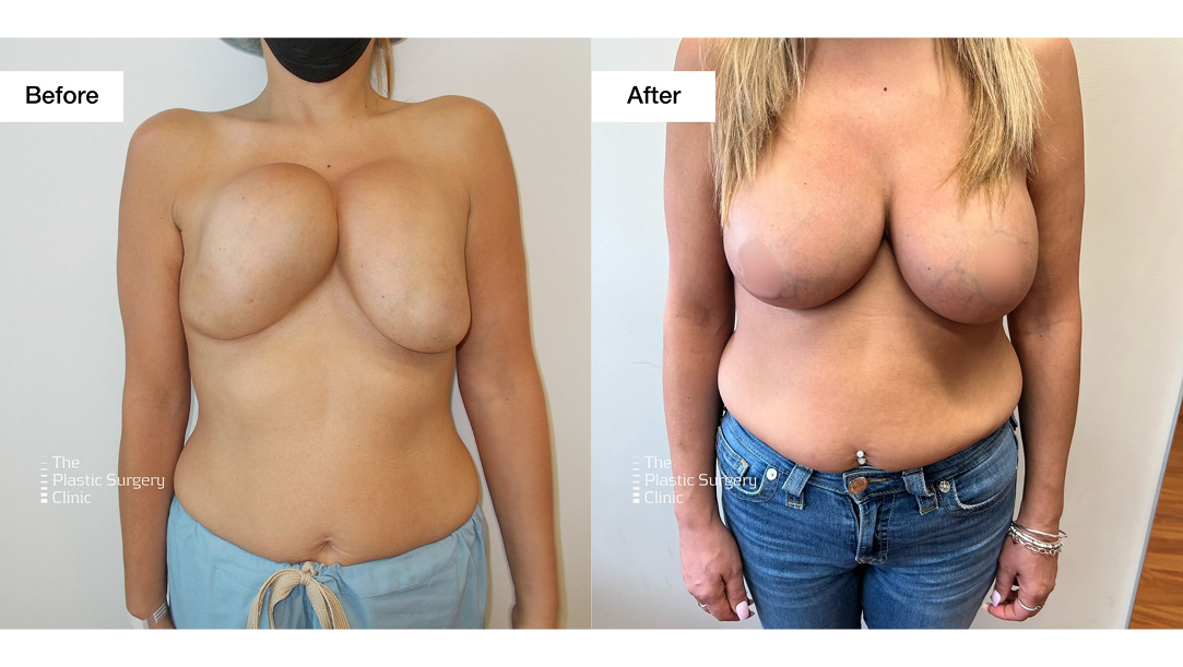 This patient had previously developed severe symmastia and capsular contraction from another clinic. This is a rare but challenging complication that can happen after a breast augmentation when the tissue between the breasts become over-dissected leading to a "uniboob" appearance. Capsular contraction occurs when the tissue surrounding the implant forms a capsule, which then contracts and tightens over time.Our patient is now 5 months post-op and recovered beautifully from the revision. Thank you for putting your trust in us! We're so honoured to have been a part of your journey