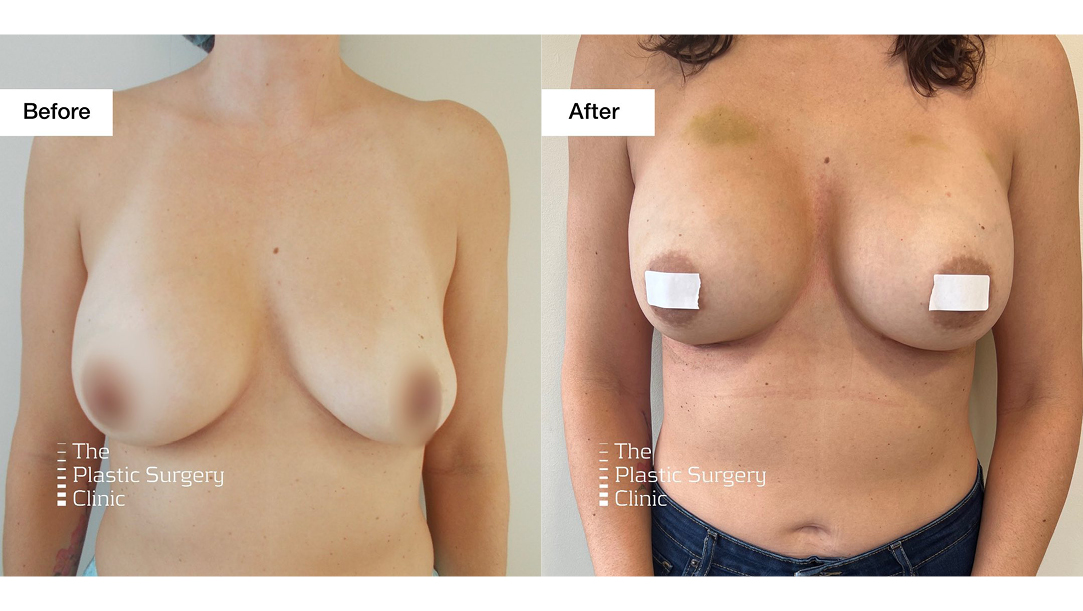 This patient is 2 weeks post-op from an open cap and replace (also known as a breast augmentation revision). She had a breast augmentation with saline implants in 2012 and her left saline implant became flat. We replaced both of her implants with cohesive gel. Cohesive gel implants are solid silicone implants, otherwise known as the "gummy bear implant." They have the amazing advantage that if for whatever reason they were to rupture or their shell were to be broken, they will not leak and they will retain their shape.